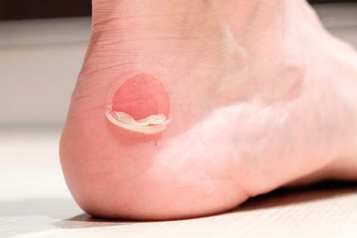 Cuidados del pie diabético que suele presentar, entre otros la aparición de ampollas y rozaduras