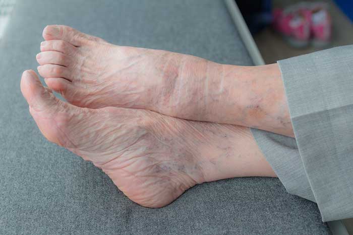 Tratamiento y cuidado de los pies en la tercera edad