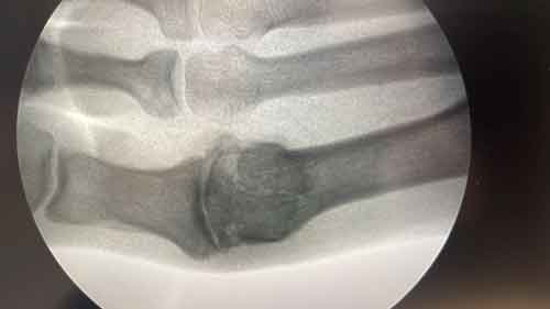 Radiografía de paciente con artrosis en los pies