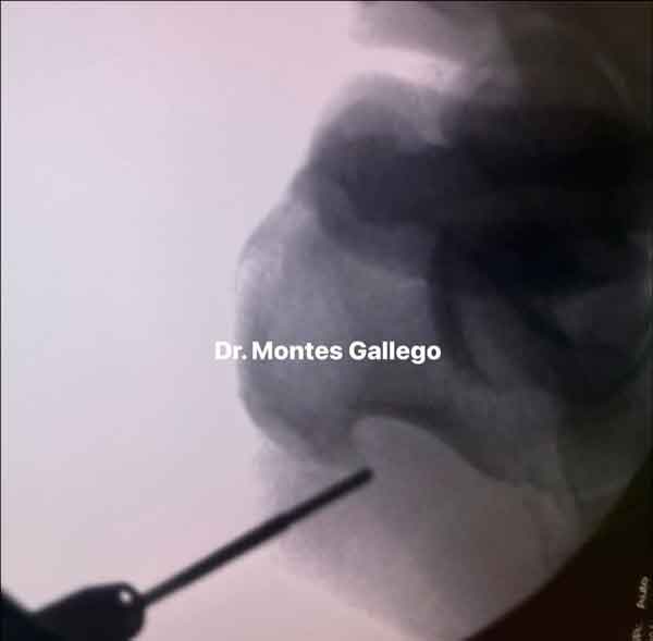 Radiografia de paciente del Dr. Montes con espolon antes de la cirugia