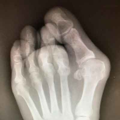 artritis en los pies radiografía