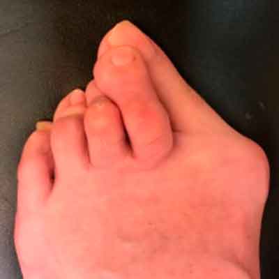 artritis en los pies
