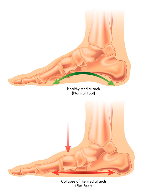 Caída del arco del pie por Disfunción del Tendón Tibial Posterior