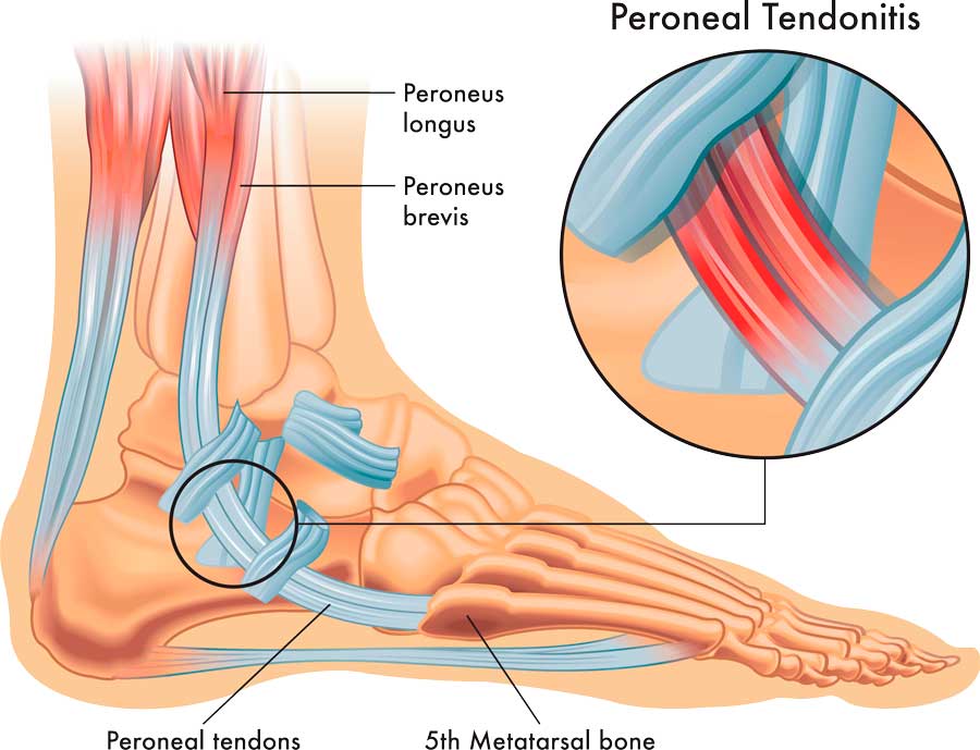 Imagen tendones peroneos del tobillo