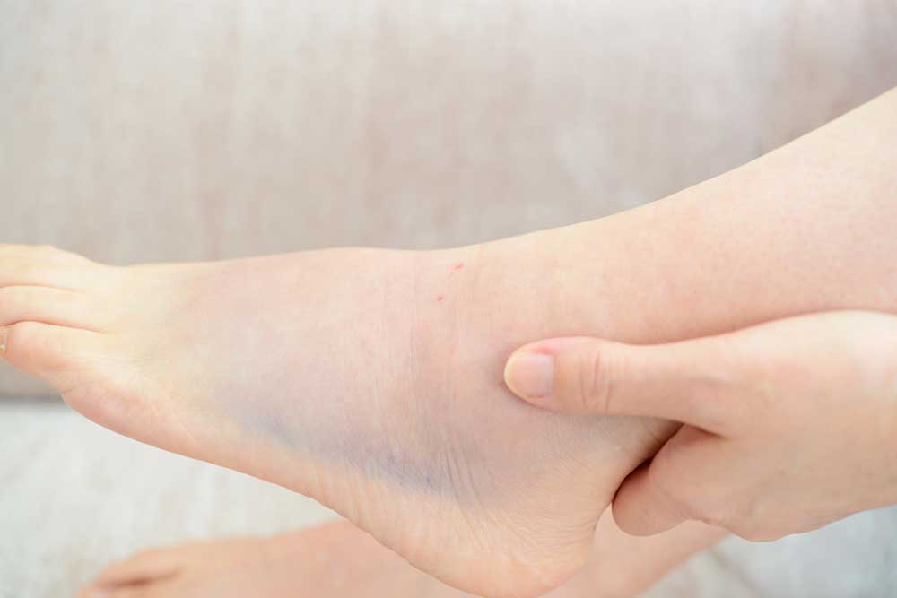 Síntomas y tratamiento de los esgunces de tobillo