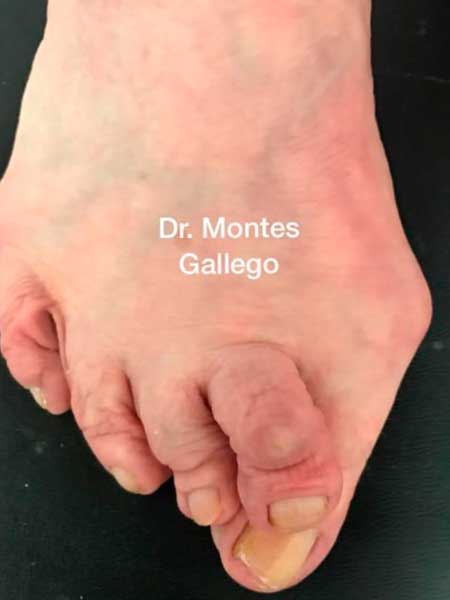 Imagen previa de Cirugía Múltiple de Hallux Valgus y Dedos Menores