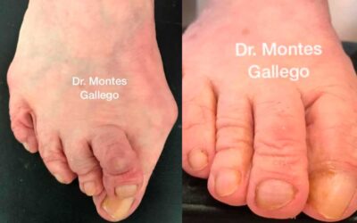 Cirugía Múltiple de Hallux Valgus y Dedos Menores