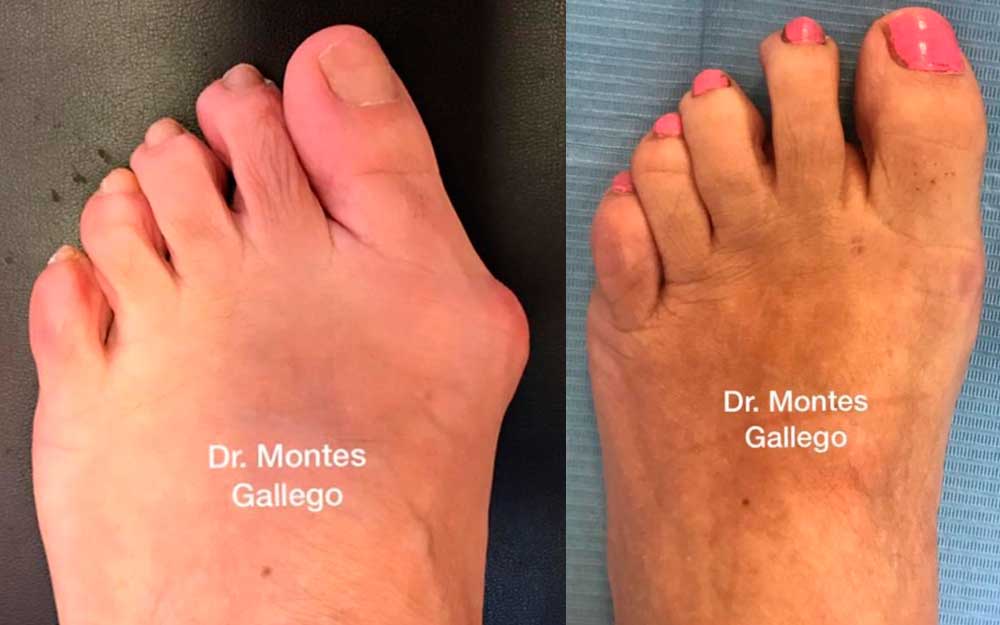 Cirugía Osteoarticular de Hallux Valgus