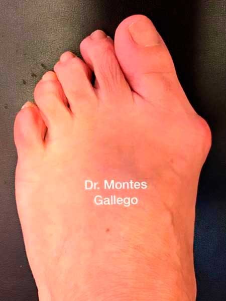 Imagen previa de cirugía osteoarticular para corrección de hallux valgus