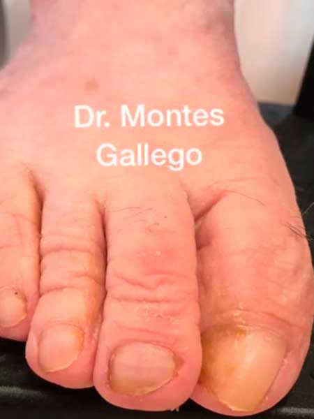 Imagen después Cirugía Múltiple de Hallux Valgus y Dedos Menores