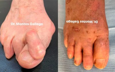 Multicirugía para Deformidad Severa de los Pies