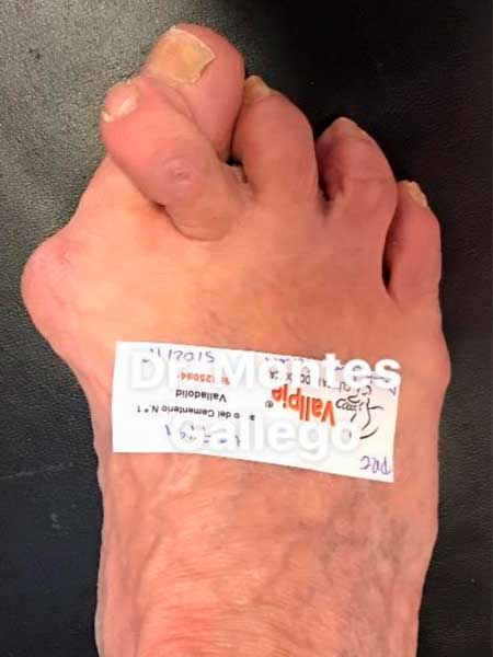 Precirugía de un Hallux Valgus y 2º Dedo