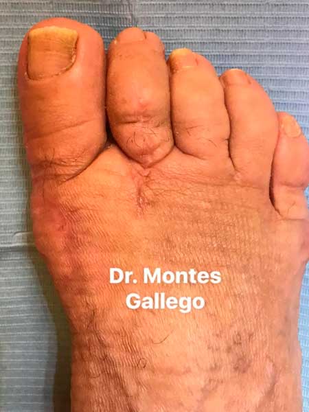 Resultados de la Cirugía del Antepié Hallux Valgus y 2º Dedo